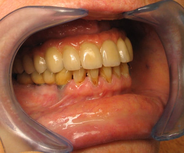 diapo11-prothese-dentaire-600x500