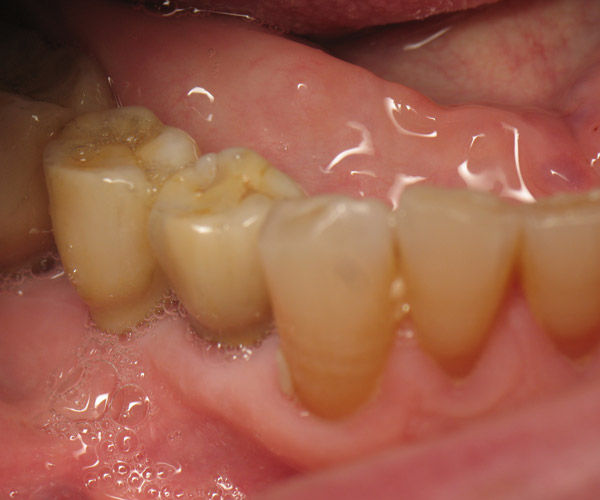 diapo7-prothese-dentaire-600x500