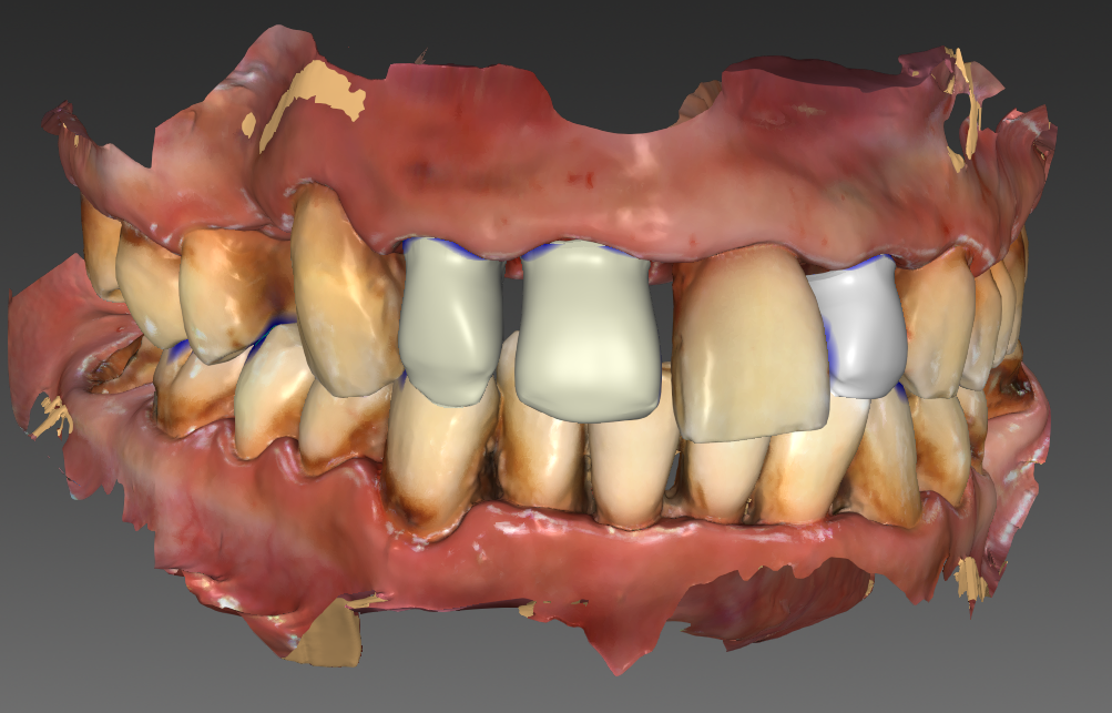 diapo8-prothese-dentaire-600x500
